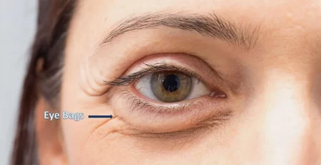 Eye Bags Removal without Surgery in Minutes Permanently