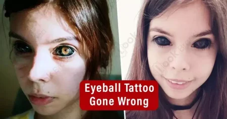 Eyeball Tattoo Gone Wrong