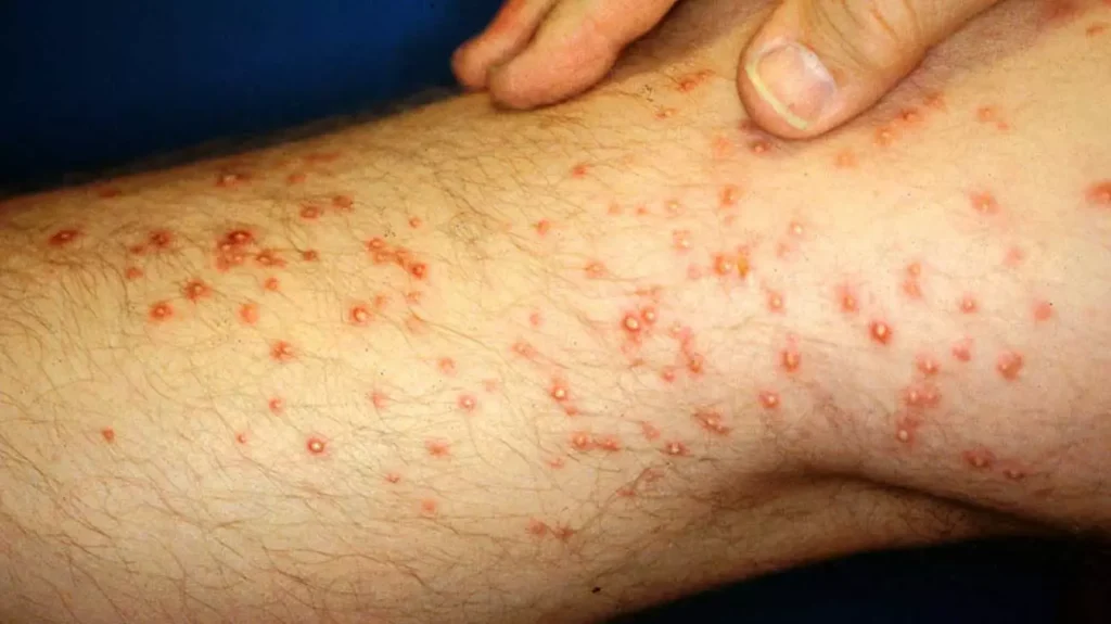 Fire Ant Stings