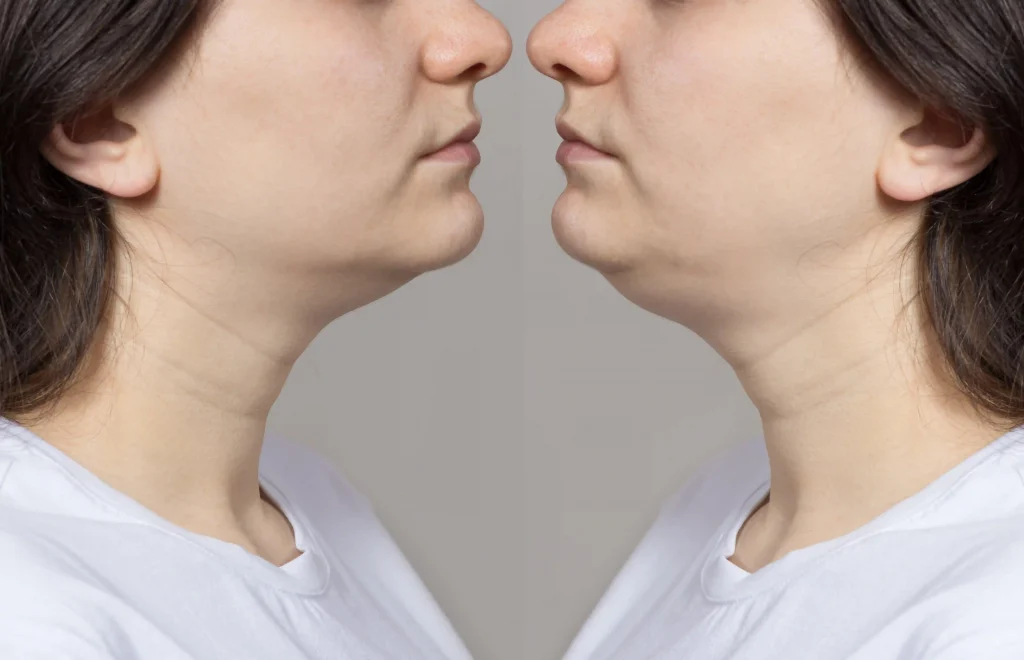 How to Lose Neck Fat Fast In A Week
