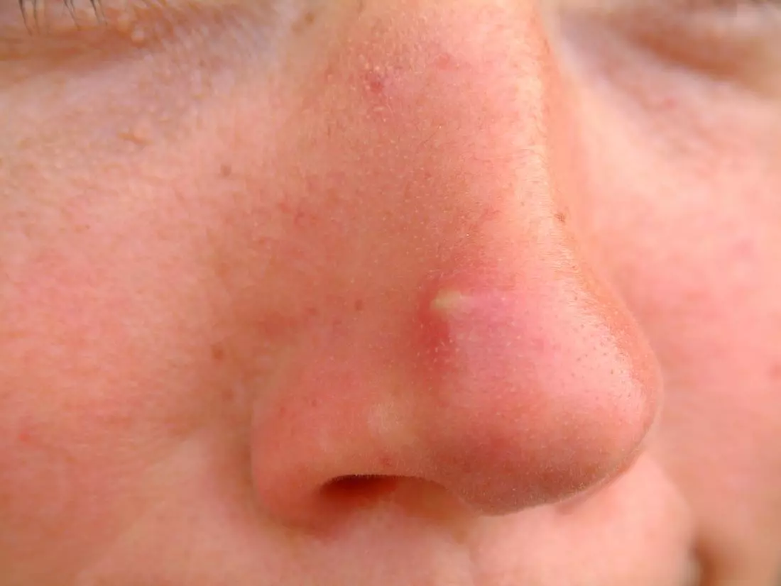 tip-of-nose-red-and-sore-to-touch-5-nasal-furuncles-cures