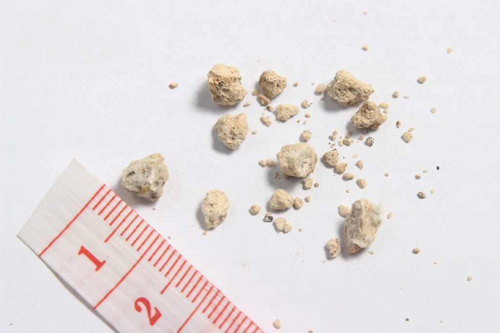 Kidney Stone Size Chart In Mm And Treatment