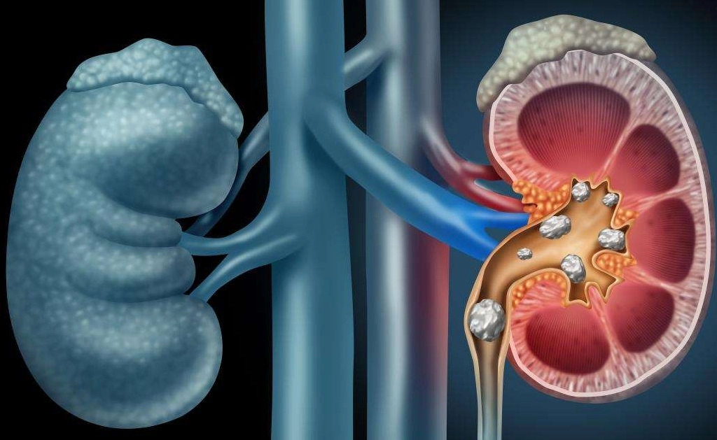 Kidney Stone Size Chart In MM CM Millimeter Centimeter 