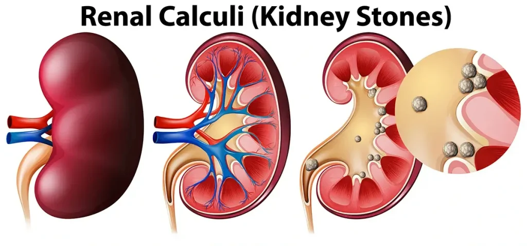 Stages of Passing a Kidney Stone