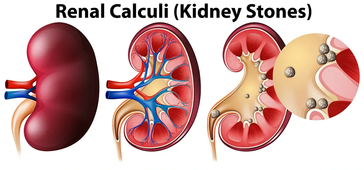 stages-of-passing-a-kidney-stone-how-long-it-takes-to-pass